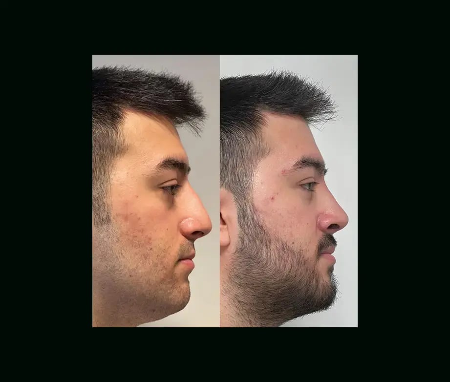 tayfun-demirel-md-rhinoplasty-before-after-46-1