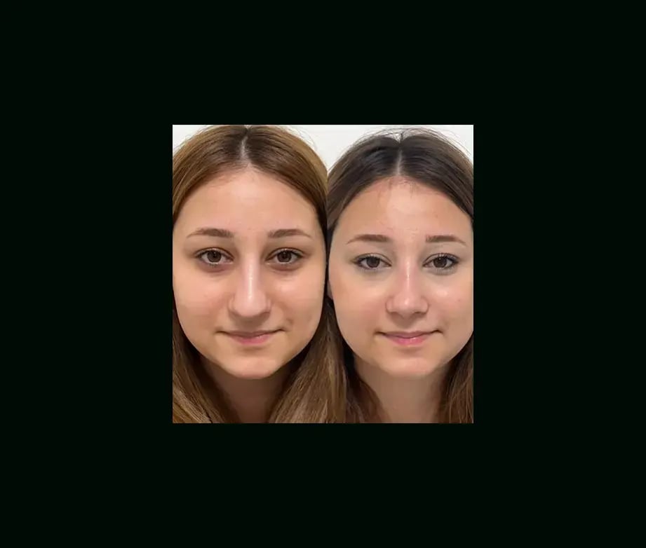 tayfun-demirel-md-rhinoplasty-before-after-7-1
