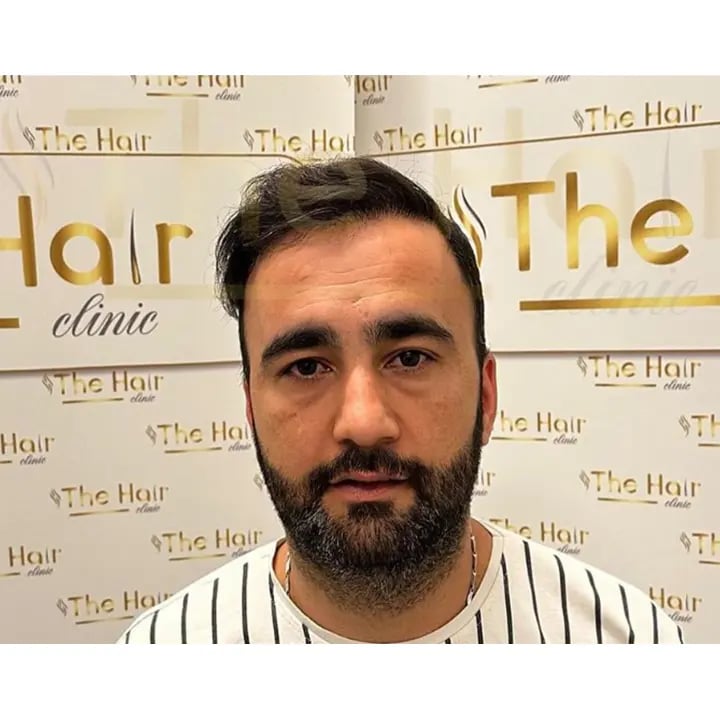 the-hair-clinic-hair-transplant-after-1-year-2