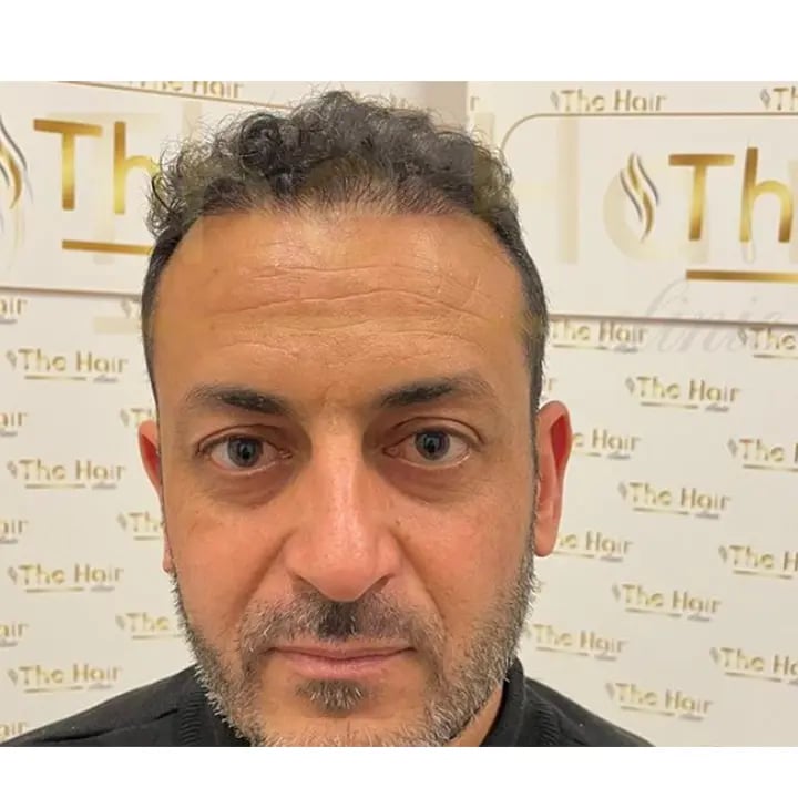 the-hair-clinic-hair-transplant-after-6-month-4