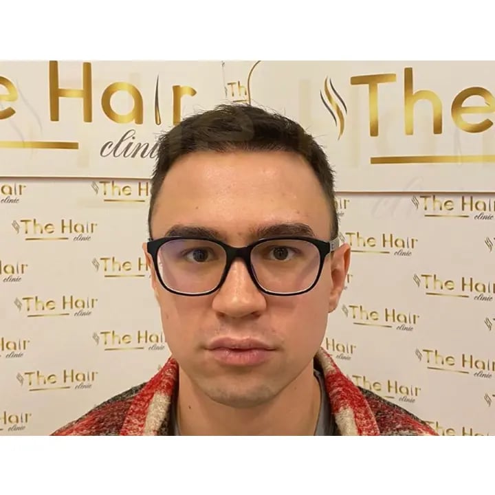 the-hair-clinic-hair-transplant-after-7-month-7