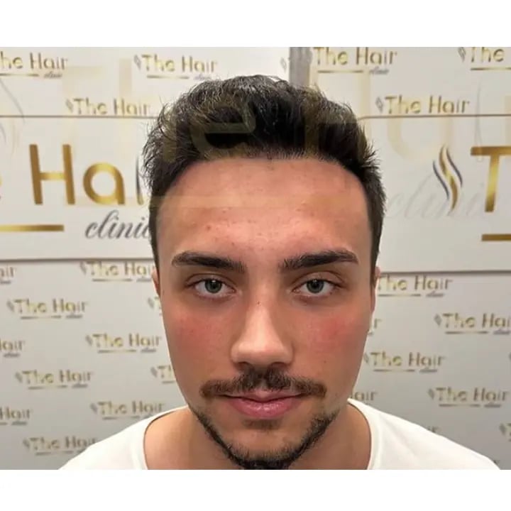 the-hair-clinic-hair-transplant-after-8-month-3