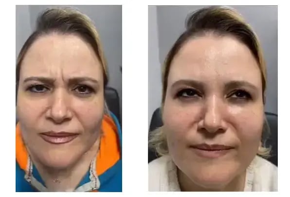 tugce-simsek-botox-before-after
