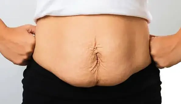 tummy-tuck-in-turkey