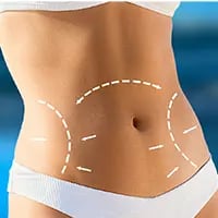 Tummy Tuck