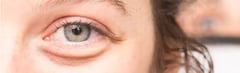 What are Under-Eye Bags?