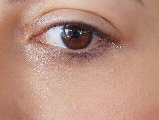 Bu***, under-eye filler with Prof. Dr. Ahmet Hakan Erbil