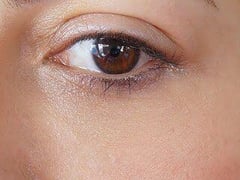Under Eye Light Filling TEOSYAL Redensity II