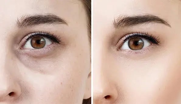 under-eye-hollows-before-after