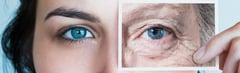 What are Under Eye Wrinkles?