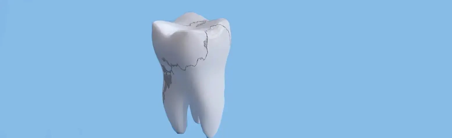 what-is-fractured-tooth
