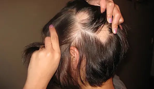 woman-alopecia-areata