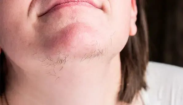 woman-hirsutism