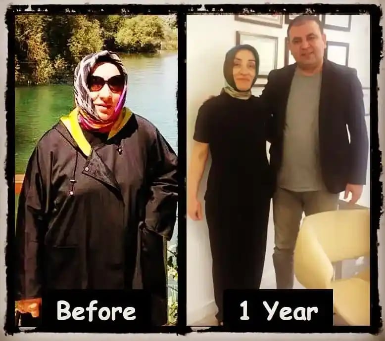 Al*** after lipedema