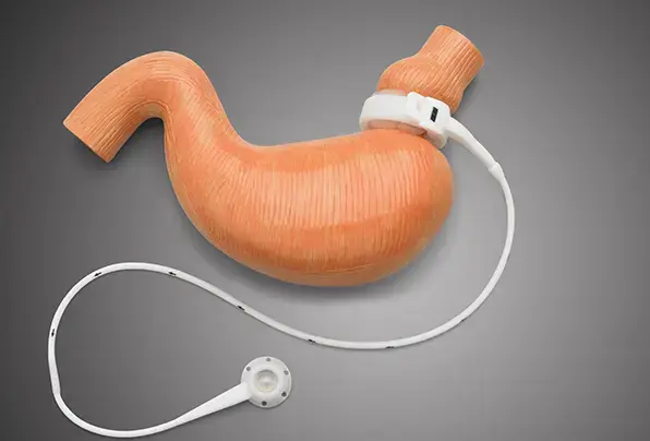 gastric-banding