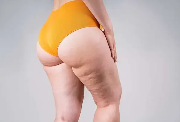 lipedema-Jun-11-2024-08-54-56-2561-AM
