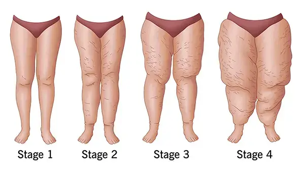 lipedema-stages