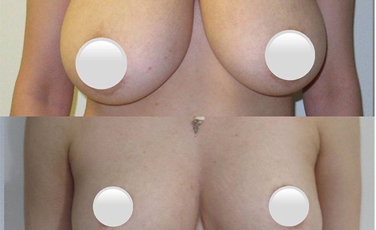 Before and after, Breast Reduction