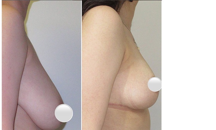 Before and after, Breast Reduction by <html lang=