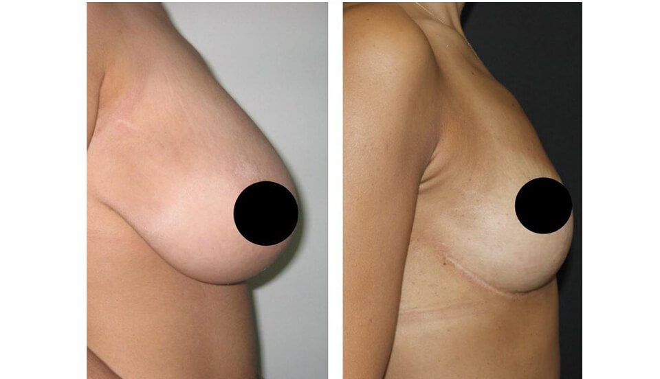 Before and after, Breast Reduction