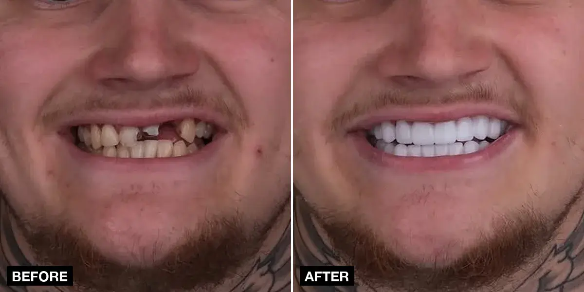 Before and after, Dental Crowns