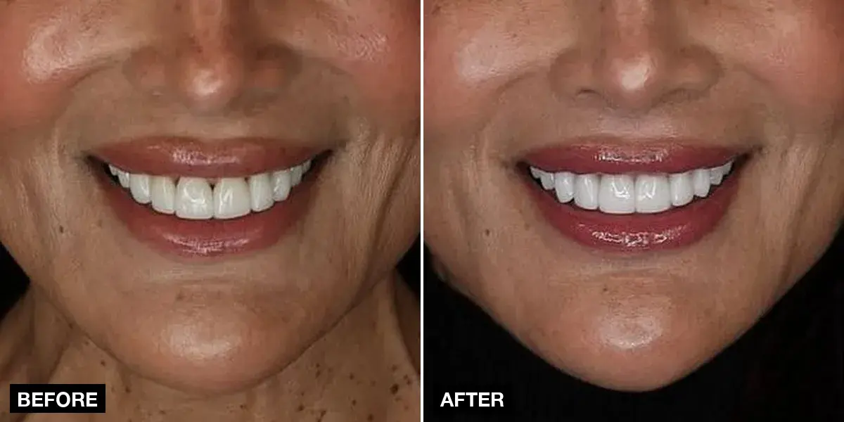 Before and after, Veneers