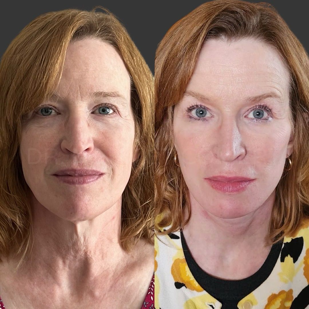 Before and after, Blepharoplasty by Dr. Mehmet Cömert