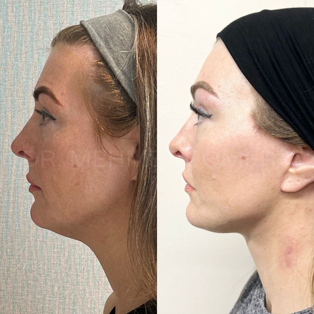 Before and after, Blepharoplasty by Dr. Mehmet Cömert