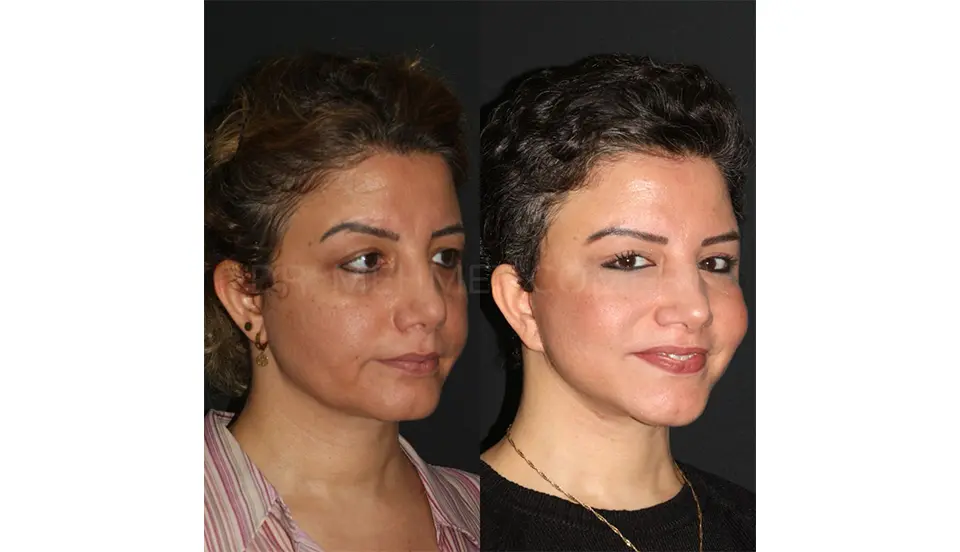 mehmet-comert-md-facelift-before-and-after-7-2
