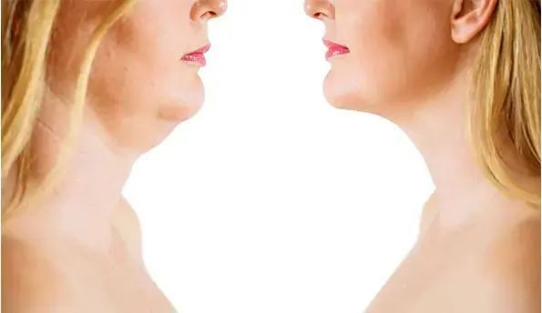 neck-fat-before-after
