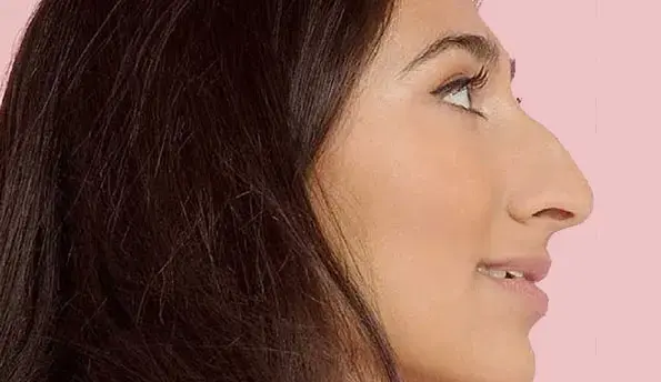 woman-hook-nose (1)-1