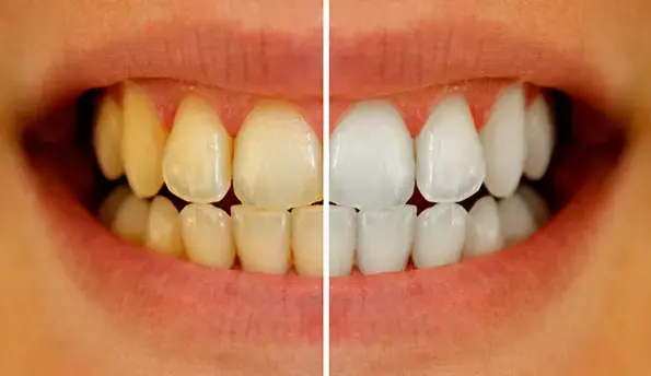 yellow-teeth-problem